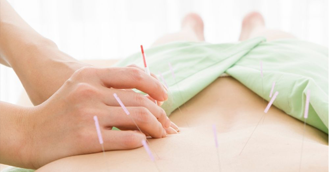 Acupuncture